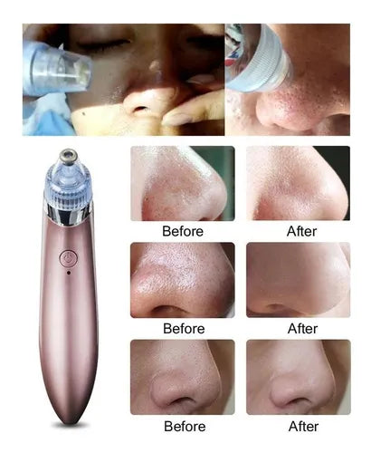 SkinClean Pro - EXTRACTOR FACIAL DE PUNTOS NEGROS Y ESPINILLAS